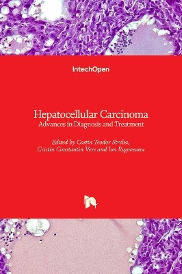 Hepatocellular Carcinoma - 