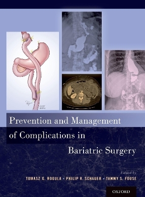 Prevention and Management of Complications in Bariatric Surgery - 