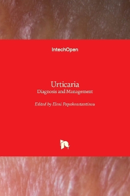 Urticaria - 