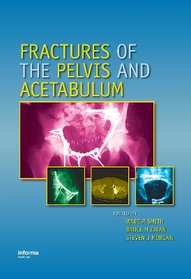 Fractures of the Pelvis and Acetabulum - 