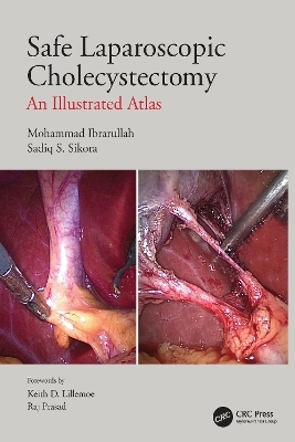 Safe Laparoscopic Cholecystectomy - Mohammad Ibrarullah, Sadiq S Sikora