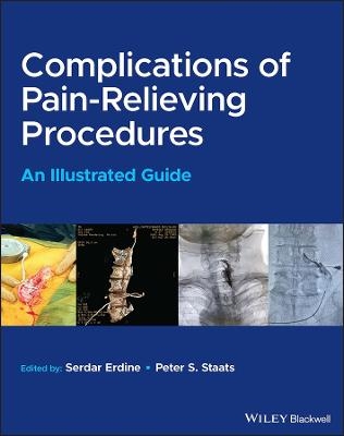 Complications of Pain-Relieving Procedures - 