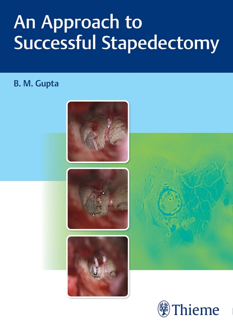 An Approach to Successful Stapedectomy - B Gupta