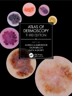 Atlas of Dermoscopy - 