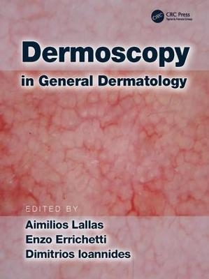Dermoscopy in General Dermatology - 