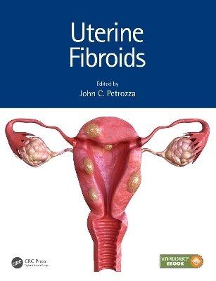 Uterine Fibroids - 