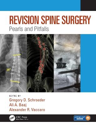 Revision Spine Surgery - 