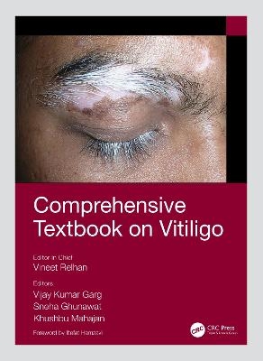 Comprehensive Textbook on Vitiligo - 