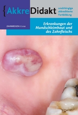 Erkrankung der Mundschleimhaut und des Zahnfleisches - Isaäc van der Waal