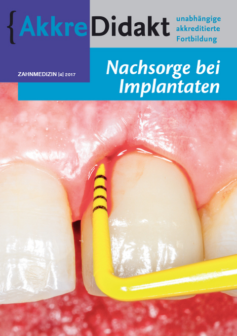 Nachsorge bei Implantaten - Gordon van der Avoort