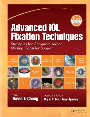 Advanced IOL Fixation Techniques - David F. Chang