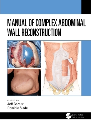 Manual of Complex Abdominal Wall Reconstruction - 