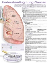 Understanding Lung Cancer Anatomical Chart - 