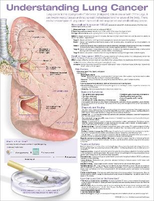 Understanding Lung Cancer Anatomical Chart