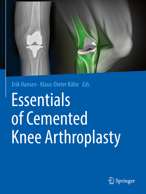 Essentials of Cemented Knee Arthroplasty - 