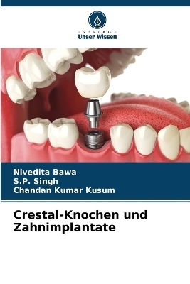 Crestal-Knochen und Zahnimplantate - Nivedita Bawa, S P Singh, Chandan Kumar Kusum