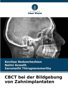 CBCT bei der Bildgebung von Zahnimplantaten - Kavitaa Nedunchezhian, Nalini Aswath, Sarumathi Thirugnanamurthy