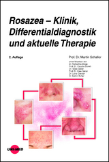 Rosazea – Klinik, Differentialdiagnostik und aktuelle Therapie - Schaller, Martin