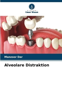 Alveolare Distraktion - Manzoor Dar