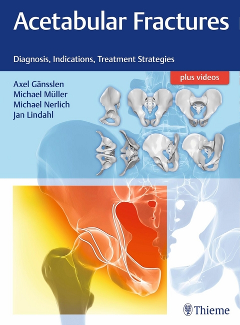 Acetabular Fractures - 