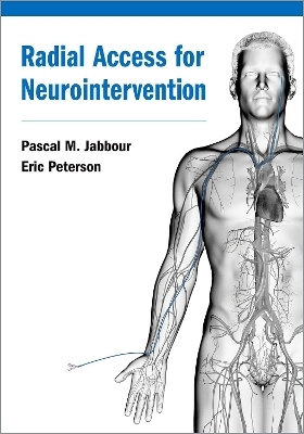 Radial Access for Neurointervention - 