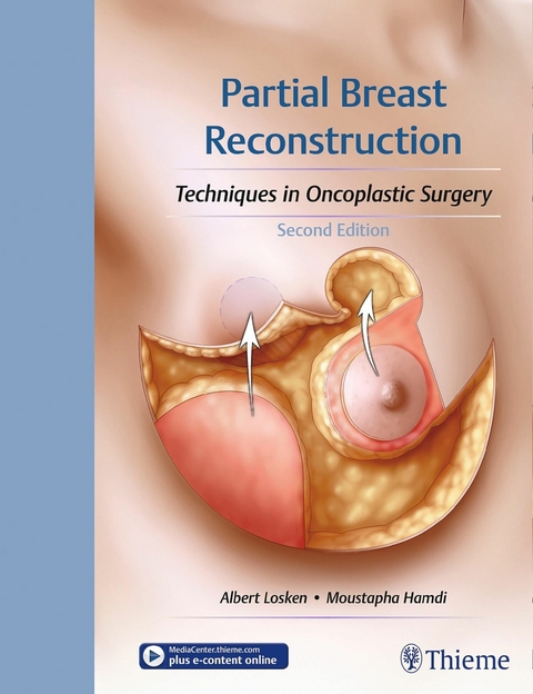 Partial Breast Reconstruction - 