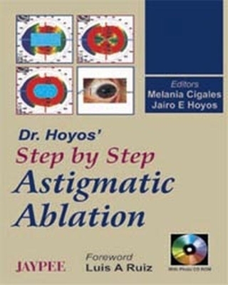 Dr. Hoyo's Step by Step Astigmatic Ablation