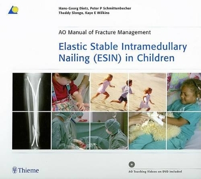 Elastic Stable Intramedullary Nailing (ESIN) in Children - Hans-Georg Dietz, Peter P Schmittenbecher, Theddy Slongo, Kaye E Wilkins