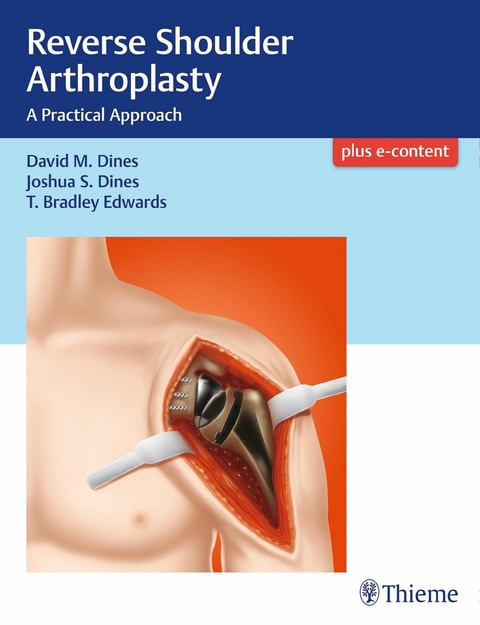 Reverse Shoulder Arthroplasty - David M. Dines, Joshua Dines, T Bradley Edwards
