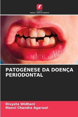 Patogénese Da Doença Periodontal - Divyata Widhani, Manvi Chandra Agarwal