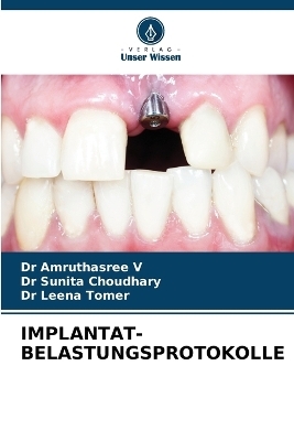 Implantat-Belastungsprotokolle - Dr Amruthasree V, Dr Sunita Choudhary, Dr Leena Tomer