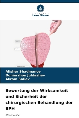 Bewertung der Wirksamkeit und Sicherheit der chirurgischen Behandlung der BPH - Alisher Shadmanov, Donierzhon Juldashev, Akram Saliev