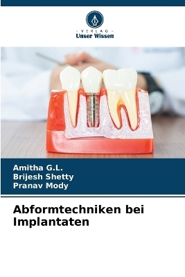 Abformtechniken bei Implantaten - Amitha G L, Brijesh Shetty, Pranav Mody