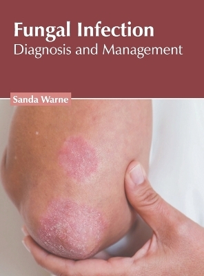 Fungal Infection: Diagnosis and Management - 