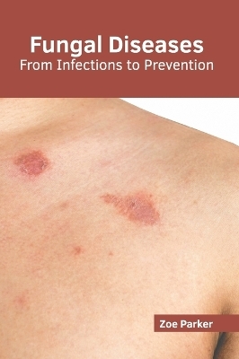 Fungal Diseases: From Infections to Prevention - 