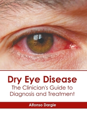 Dry Eye Disease: The Clinician's Guide to Diagnosis and Treatment - 