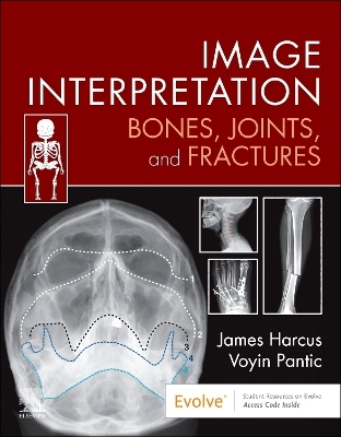 Image Interpretation: Bones, Joints, and Fractures - James Harcus, Voyin Pantic