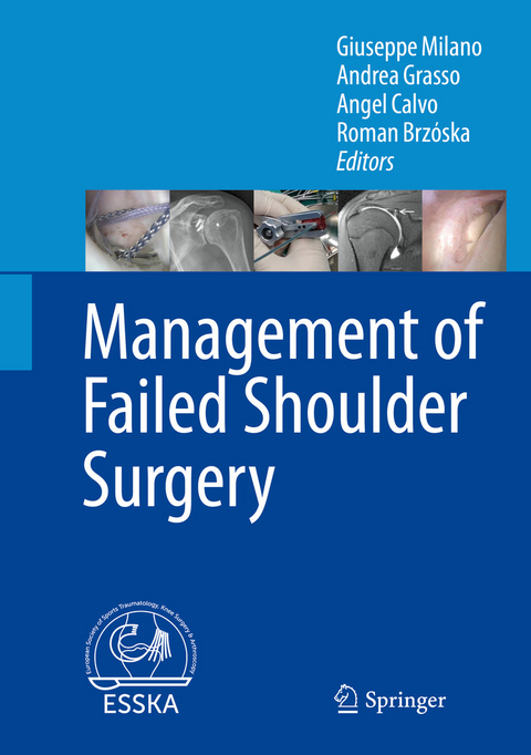 Management of Failed Shoulder Surgery - 