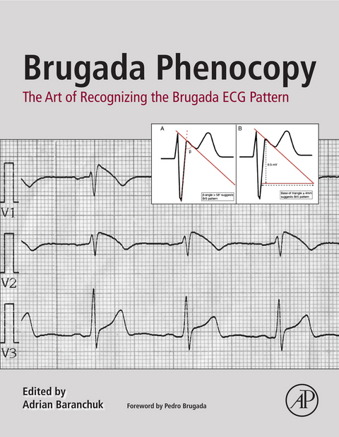 Brugada Phenocopy - 