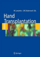 Hand transplantation - 