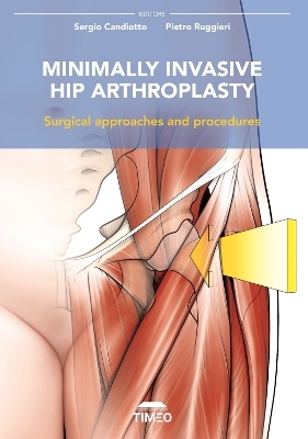 Minimally Invasive Hip Arthroplasty - 