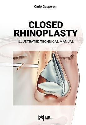 Closed Rhinoplasty - Carlo Gasperoni