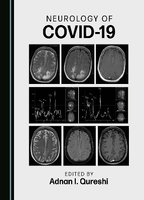 Neurology of COVID-19 - 