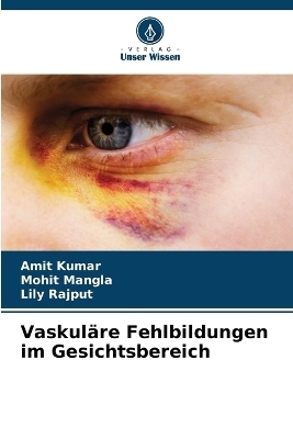 Vaskul�re Fehlbildungen im Gesichtsbereich - Amit Kumar, Mohit Mangla, Lily Rajput