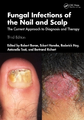 Fungal Infections of the Nail and Scalp - 