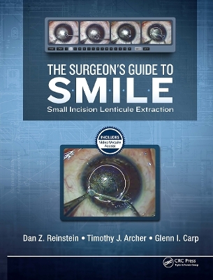 The Surgeon’s Guide to SMILE - Dan Reinstein, Timothy Archer, Glenn Carp