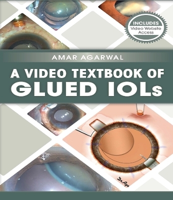 A Video Textbook of Glued IOLs - Amar Agarwal