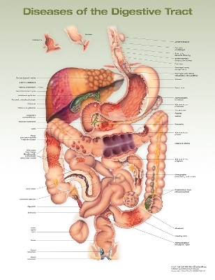 Diseases of the Digestive Tract Anatomical Chart -  Anatomical Chart Company