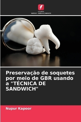 Preserva��o de soquetes por meio de GBR usando a "T�CNICA DE SANDWICH" - Nupur Kapoor