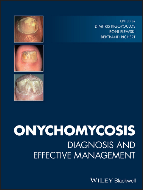 Onychomycosis - 